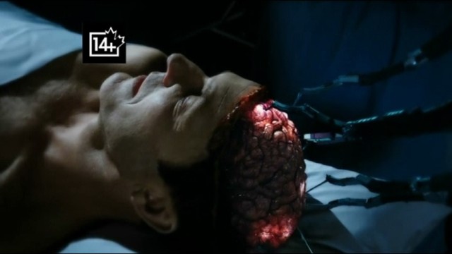 Agents of SHIELD S1x11 - Couslon gets his brain repaired on the operating table